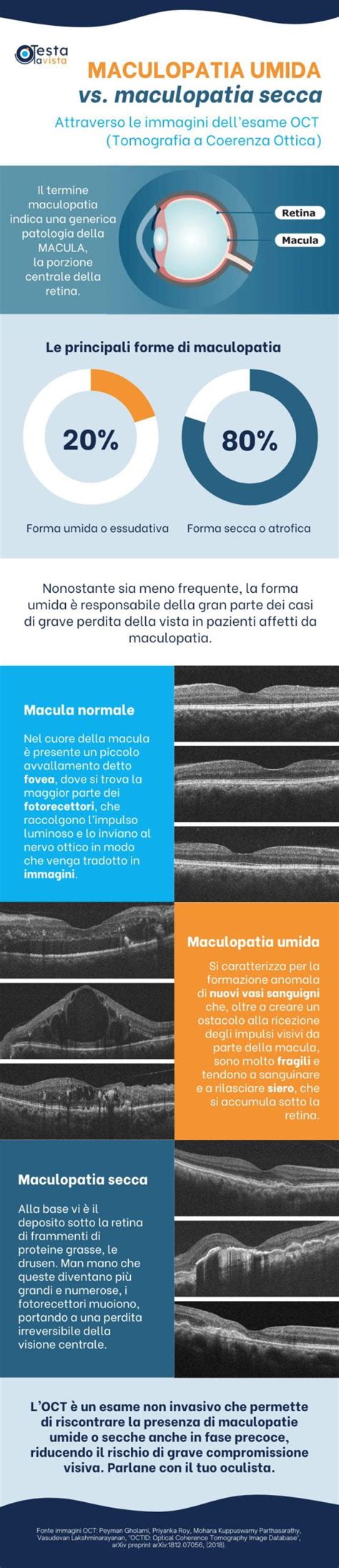 Infografica sulla maculopatia essudativa e l'importanza dell'OCT