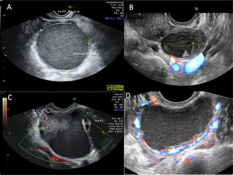Diagramma che illustra la struttura di un endometrioma ovarico, evidenziando le pareti ispessite e il contenuto denso