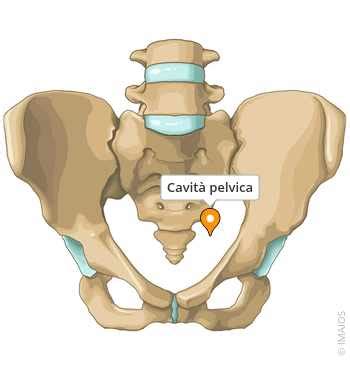 rappresentazione schematica dell'endometriosi nella cavità pelvica femminile