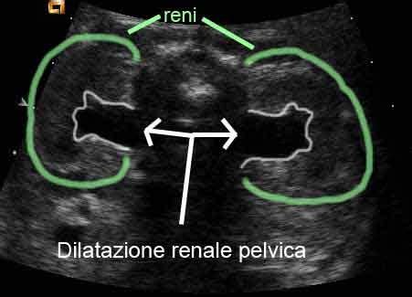 rappresentazione schematica dell'anatomia renale fetale e dilatazione della pelvi