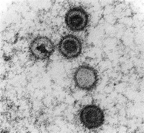 Virus Epstein-Barr al microscopio elettronico