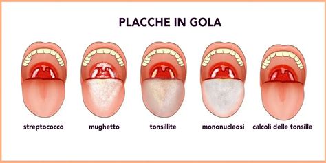 illustrazione schematica di una gola infiammata e sollievo dato da uno spray orale