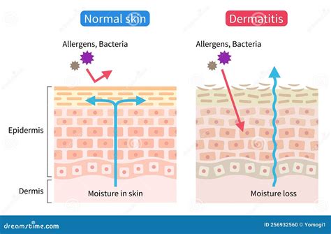 illustrazione scientifica della barriera cutanea sana vs pelle atopica