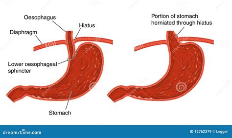 Diagramma anatomico dello iato esofageo e dello stomaco