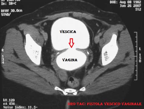 Diagramma di una fistola vescico-vaginale