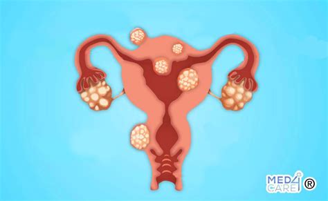 Rappresentazione anatomica dell'utero con fibromi