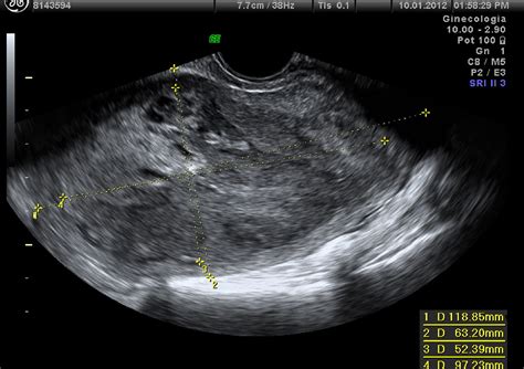Ecografia transvaginale di un fibroma uterino