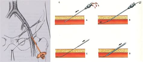 Embolizzazione arteriosa uterina