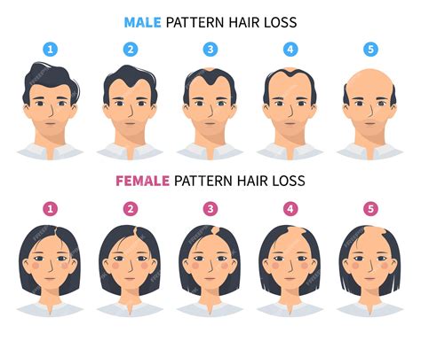 Grafico comparativo degli stadi di calvizie maschile e femminile