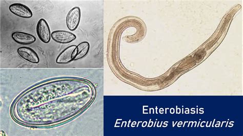 rappresentazione microscopica di Enterobius vermicularis