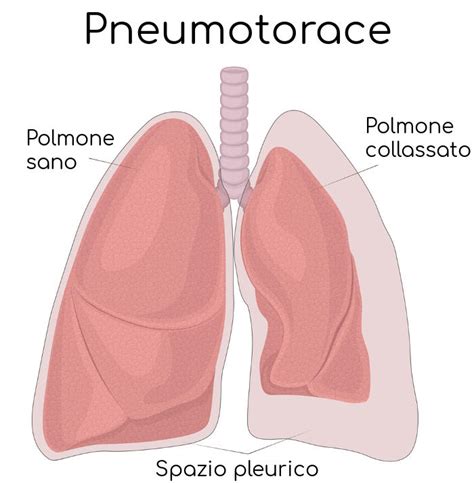 rappresentazione schematica dell'anatomia toracica e della dinamica del pneumotorace nel neonato