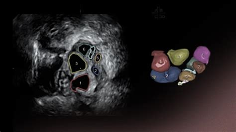 ecografia transvaginale per il conteggio dei follicoli antrali