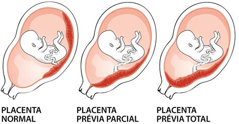 Confronto tra placenta normale e placenta previa