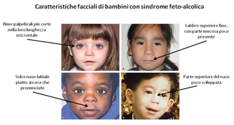 Caratteristiche facciali tipiche della FAS