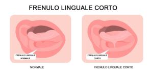 Illustrazione del frenulo linguale corto e del suo impatto