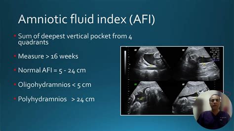 Schema ecografico per il calcolo dell'Amniotic Fluid Index (AFI)