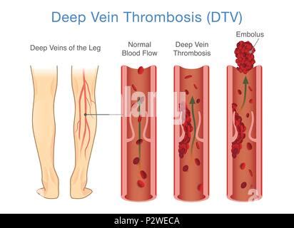Illustrazione anatomica della Trombosi Venosa Profonda (TVP)