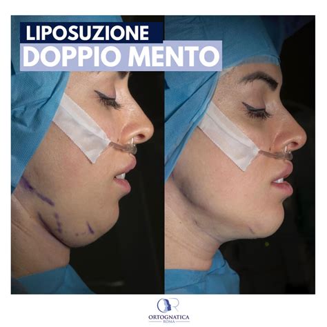 Zone trattabili con liposuzione