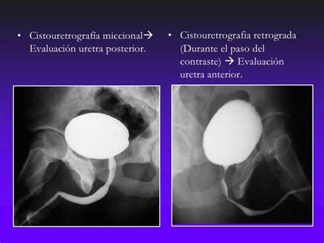 Cistouretrografia minzionale
