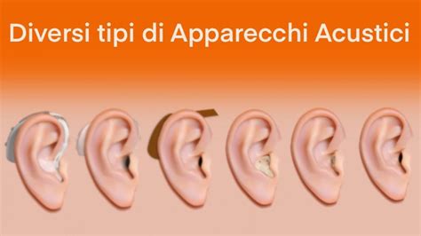 infografica che mostra i diversi tipi di apparecchi acustici e gli accessori associati