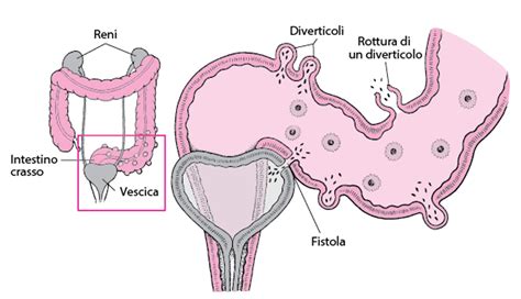 diagramma delle complicanze della diverticolite