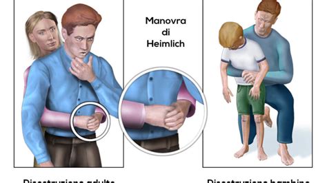 Illustrazione passo-passo della manovra di Heimlich in un bambino più grande