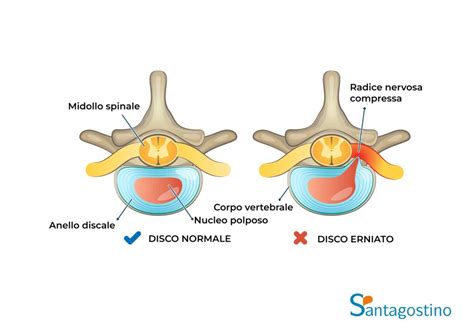 Disco intervertebrale e ernia