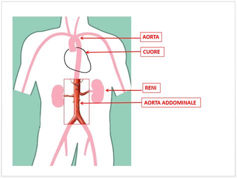 schema anatomico dell'aorta e localizzazione tipica dell'aneurisma addominale