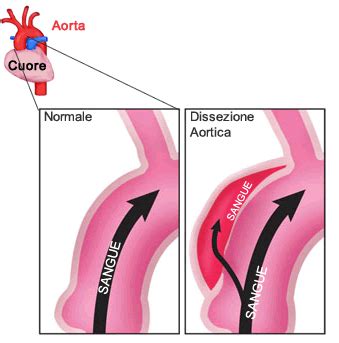 diagramma comparativo: aneurisma aortico vs dissezione aortica