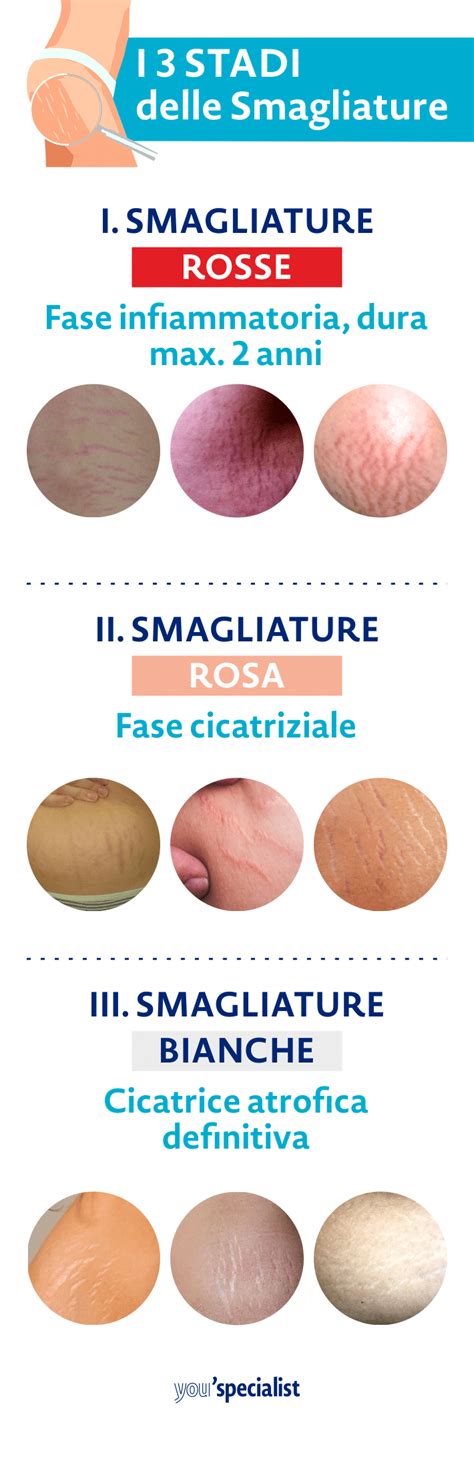 Schema delle fasi di sviluppo delle smagliature (rosse e bianche)