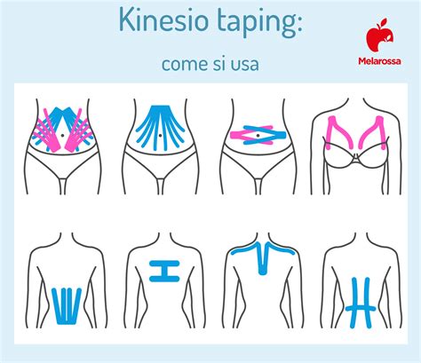 Applicazione del taping estetico per smagliature