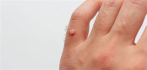 Bambino con verruca sulla mano