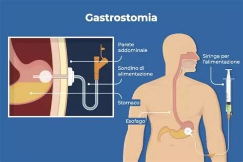 schema posizionamento sondino gastrostomia G e GJ