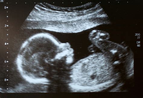 Donna incinta che fa ecografia
