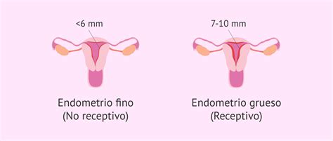 Utero sano e endometrio