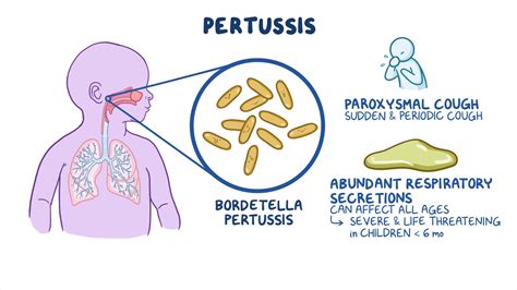 Infant pertussis symptoms illustration