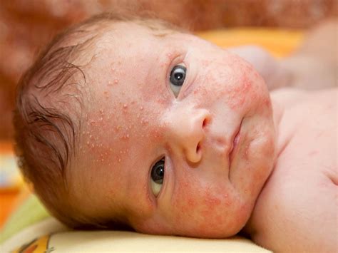 Pelle secca e arrossata di un neonato con dermatite atopica
