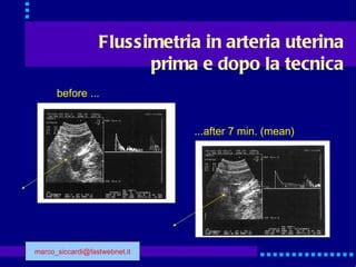 Grafico della flussimetria dell'arteria uterina
