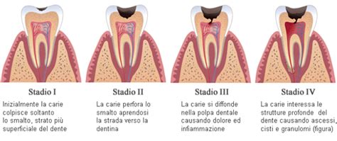 Immagine che mostra diversi stadi della carie su denti da latte