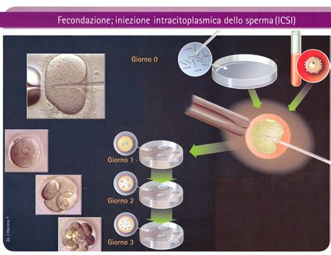rappresentazione schematica dell'iniezione intracitoplasmatica dello spermatozoo nell'ovocita