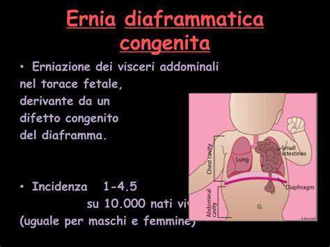 Diagramma di ernia diaframmatica congenita