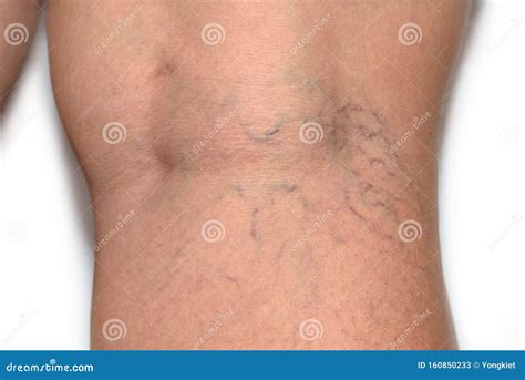 Donna incinta con vene varicose sulle gambe