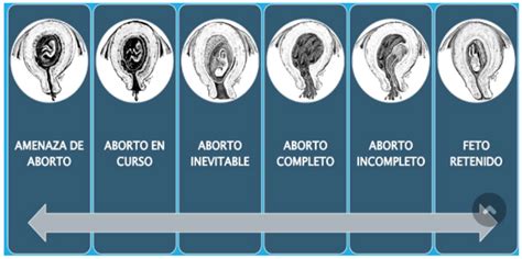 Diagramma che illustra i diversi tipi di aborto e le fasi gestazionali in cui vengono generalmente eseguiti.