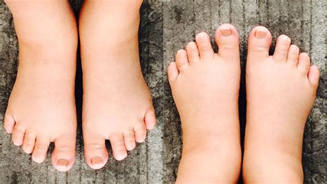Piedi gonfi in gravidanza