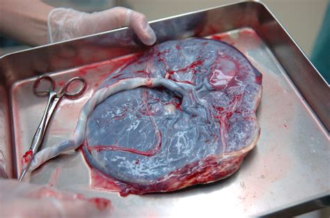 diagramma che illustra la differenza tra placenta sana e placenta con infarti e ridotta perfusione