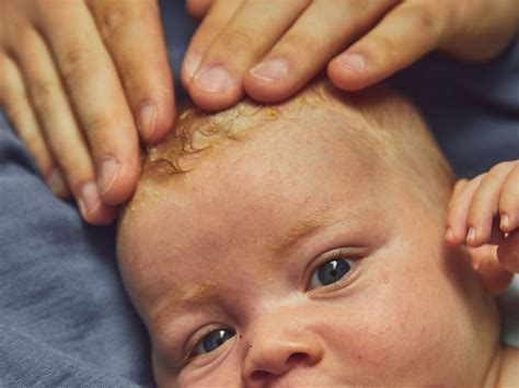 Trattamento crosta lattea neonato