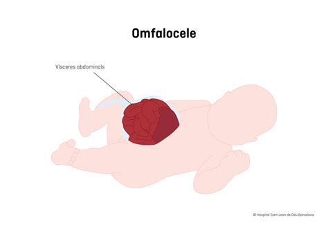Onfalocele in un neonato