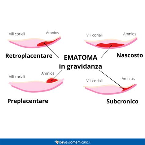 Ematoma retroplacentare