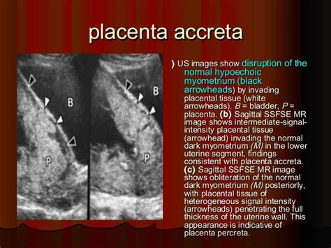 Placenta accreta ecografia