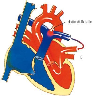 Chiusura del dotto arterioso di Botallo dopo la nascita